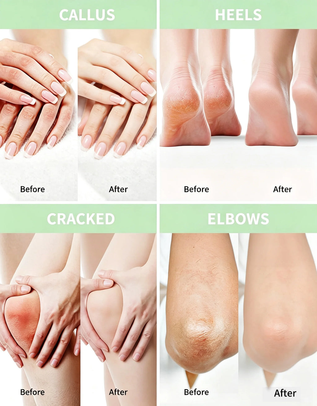 WIYUN 40% Urea Cream 2% Salicylic Acid – Hand & Foot Cream Foot & Hand Cream SPOT