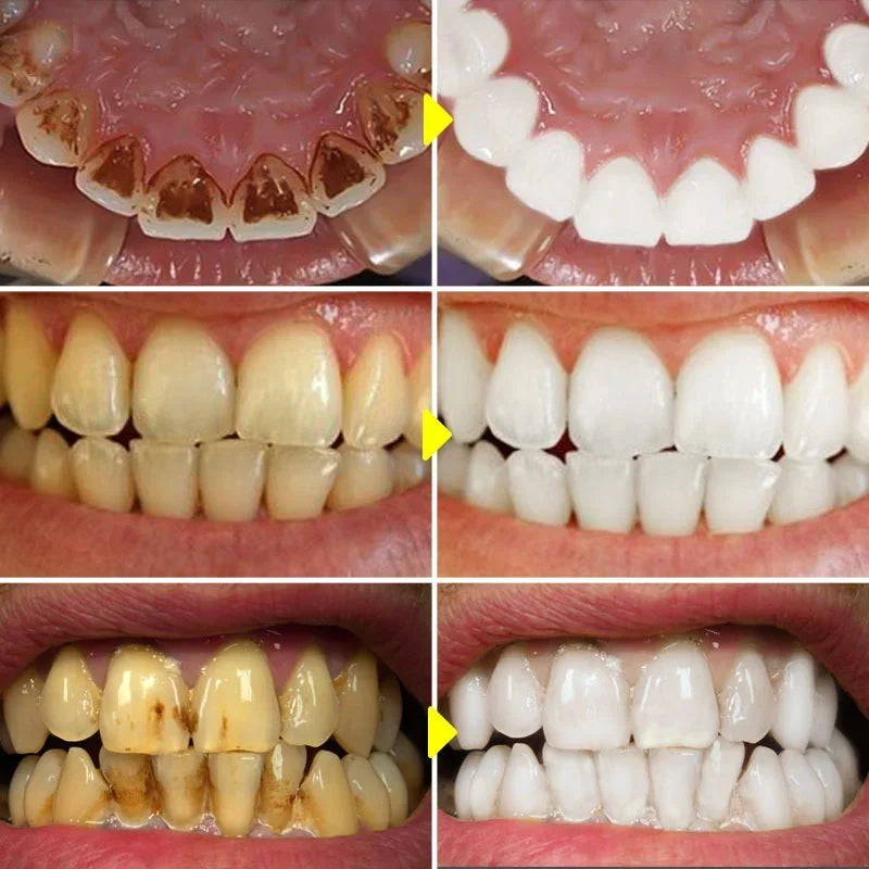 Eelhoe SP-6 Probiotic Whitening Toothpaste 120g – Stain Removal Whitening Toothpaste SPOT