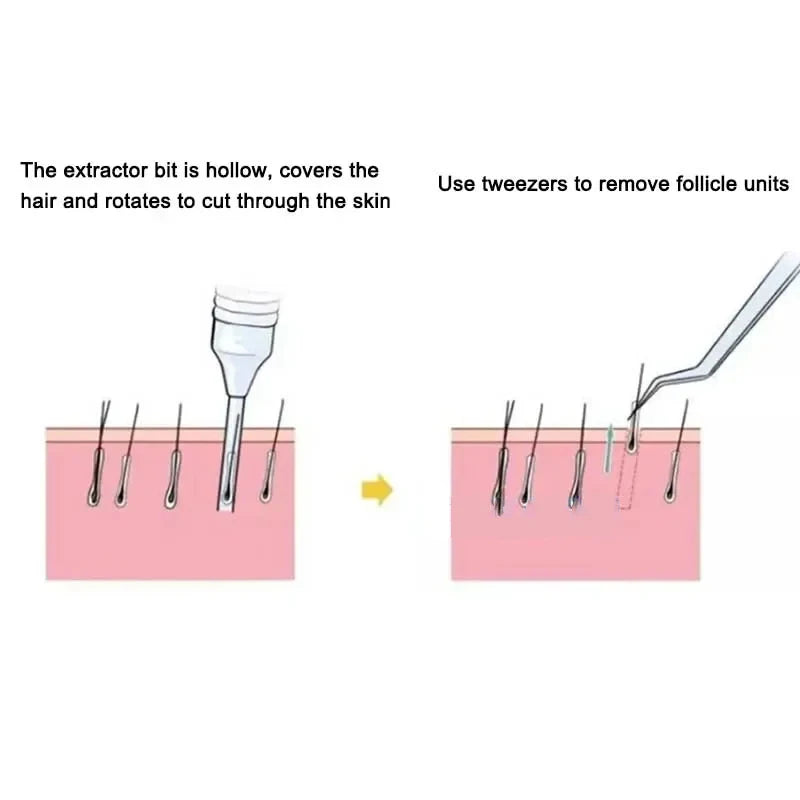 FUE Punch Needle Tubes 16.1mm Stainless Steel – 5 or 10 Pack FUE Punch Needle Tubes SPOT
