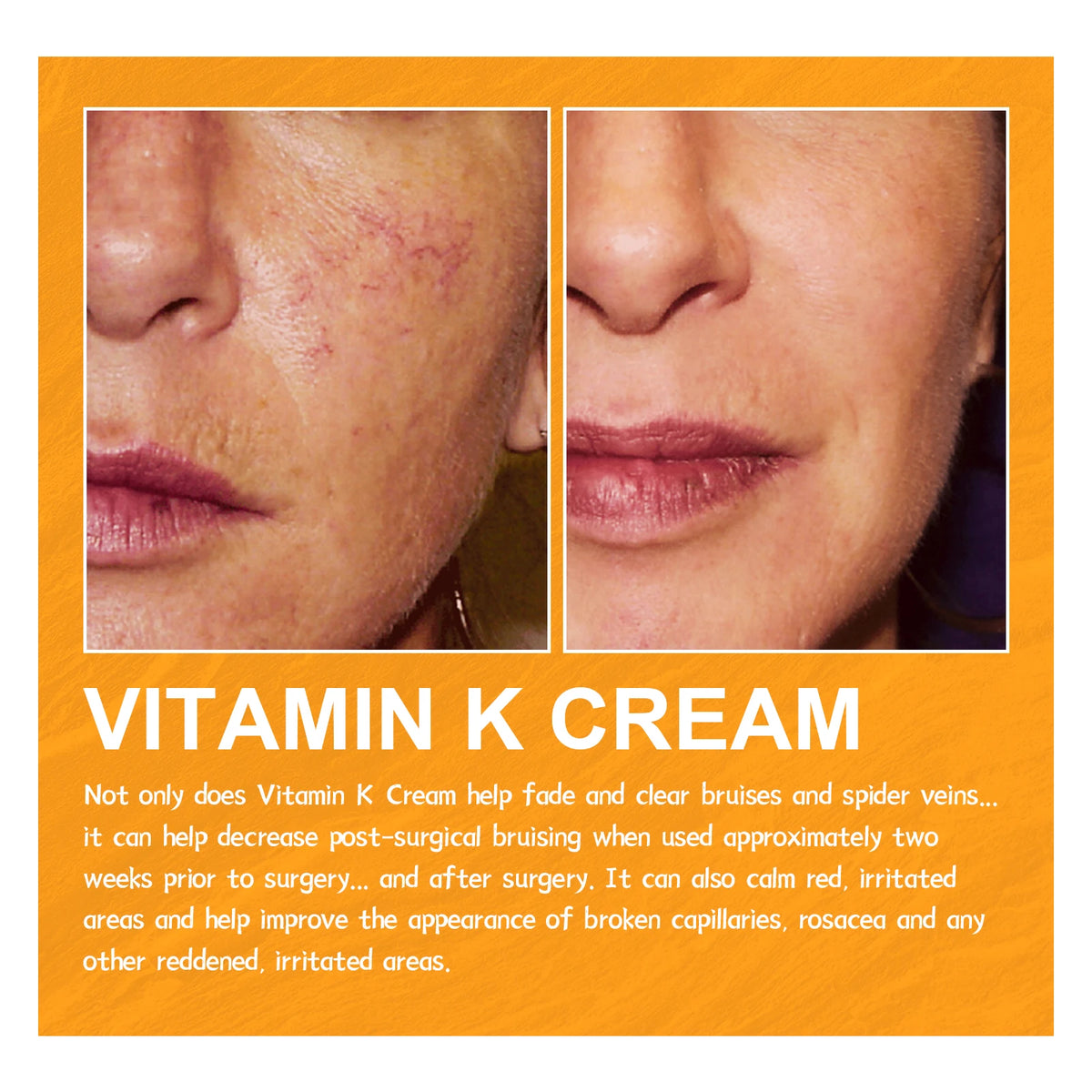 Eelhoe Vitamin K Cream – Leg & Skin Massage Cream 60g Vitamin K Skin Cream SPOT