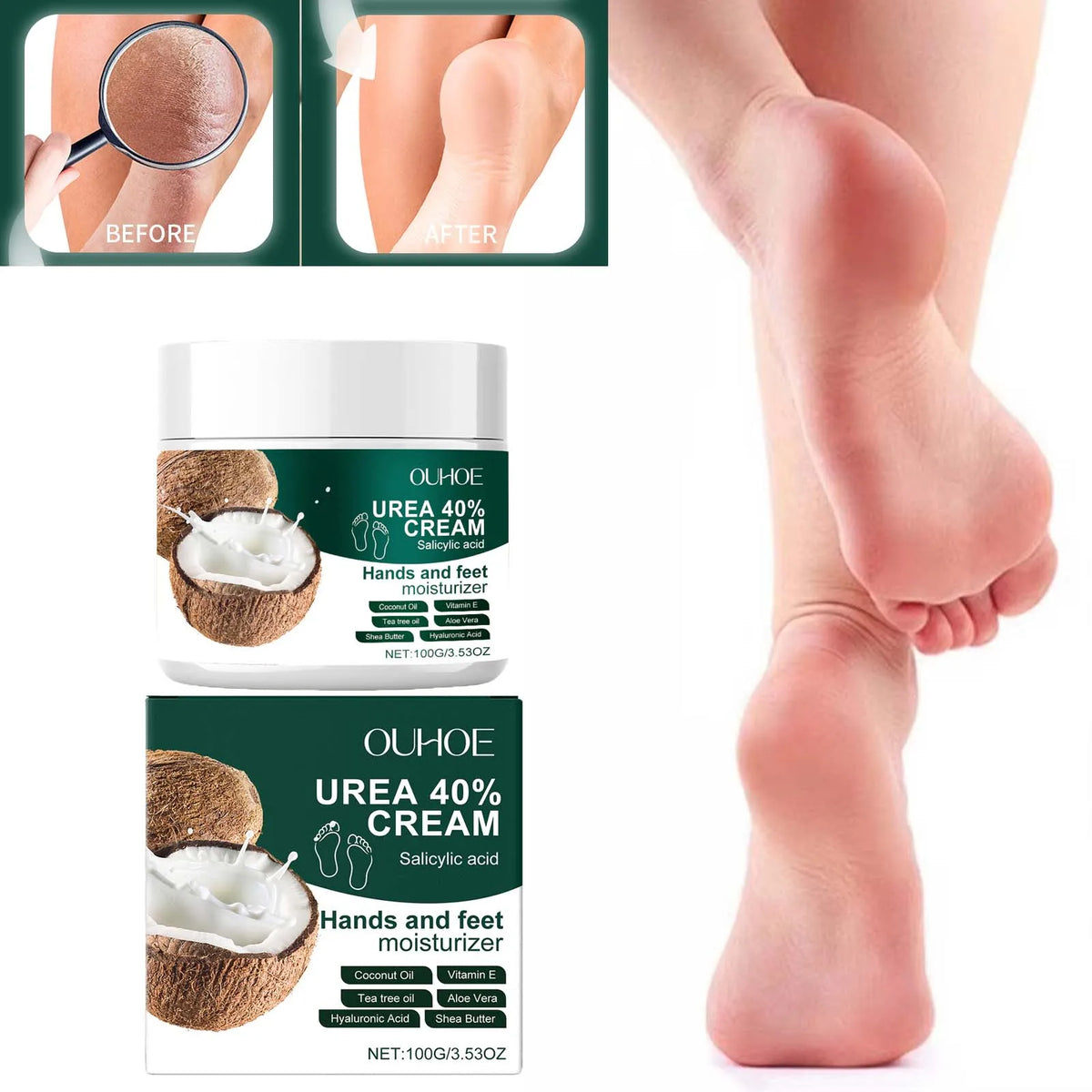 Urea 40% Foot Cream with Salicylic Acid – Callus & Dry Skin Foot & Hand Cream SPOT